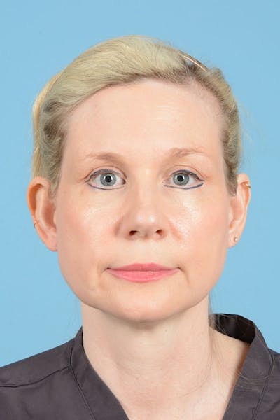 Facelift Before & After Gallery - Patient 235836 - Image 1