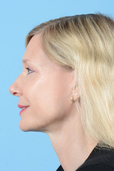 Facelift Before & After Gallery - Patient 235836 - Image 8