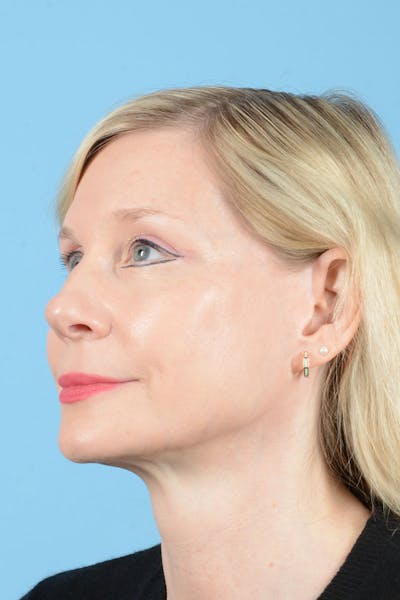 Facelift Before & After Gallery - Patient 235836 - Image 6