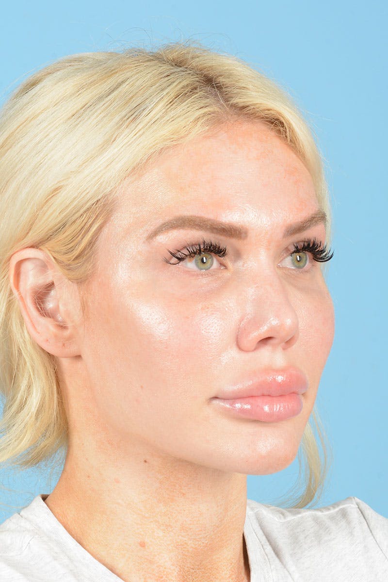 Rhinoplasty Before & After Gallery - Patient 472970 - Image 9