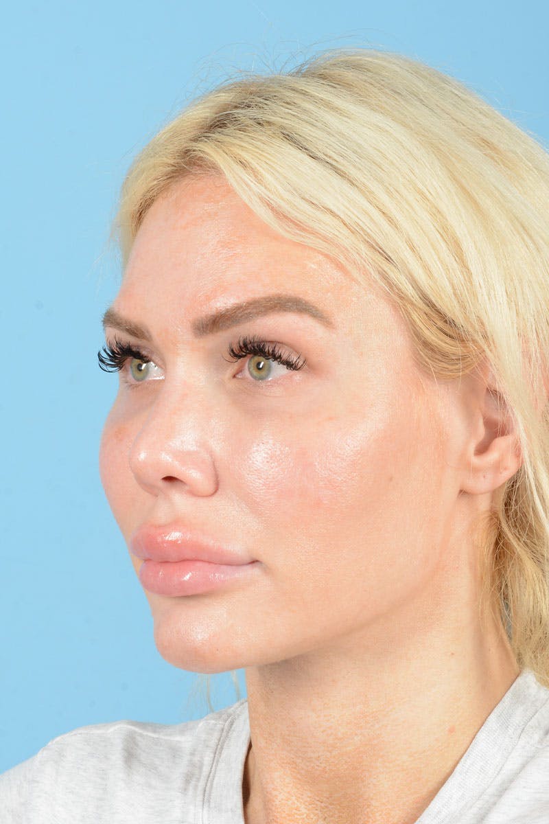 Rhinoplasty Before & After Gallery - Patient 472970 - Image 3
