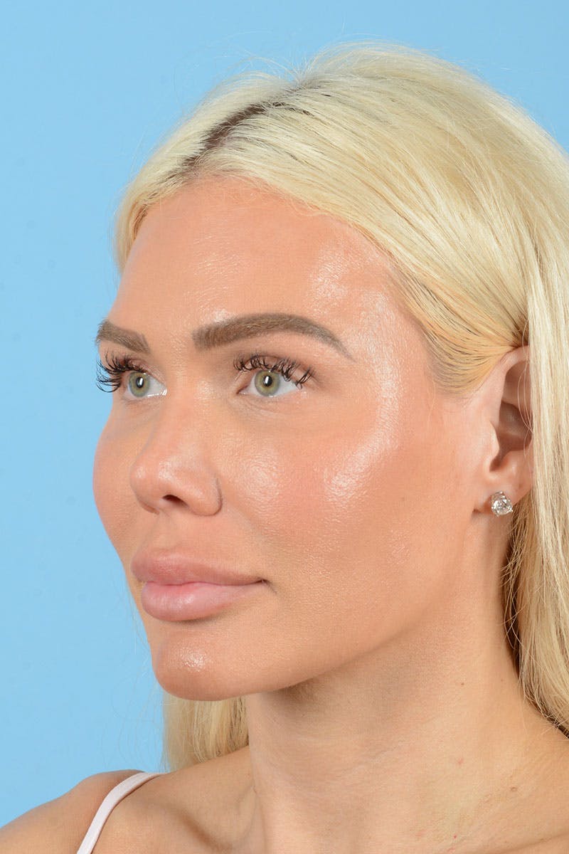 Rhinoplasty Before & After Gallery - Patient 472970 - Image 4