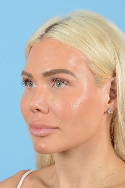 Rhinoplasty Before & After Gallery - Patient 472970 - Image 4