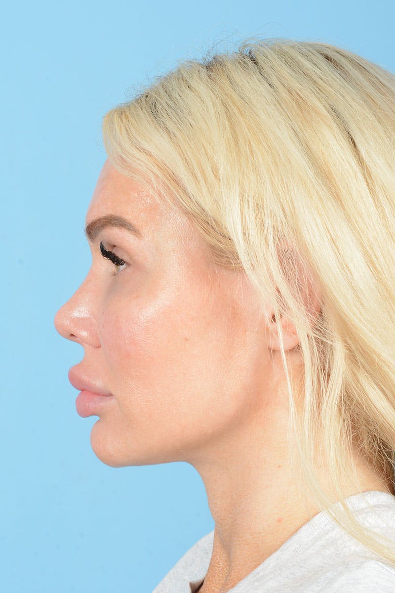Rhinoplasty Before & After Gallery - Patient 472970 - Image 5