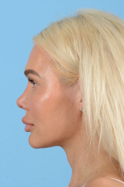 Rhinoplasty Before & After Gallery - Patient 472970 - Image 6