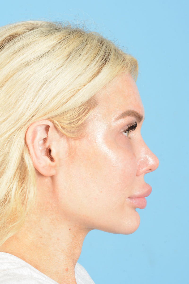 Rhinoplasty Before & After Gallery - Patient 472970 - Image 7