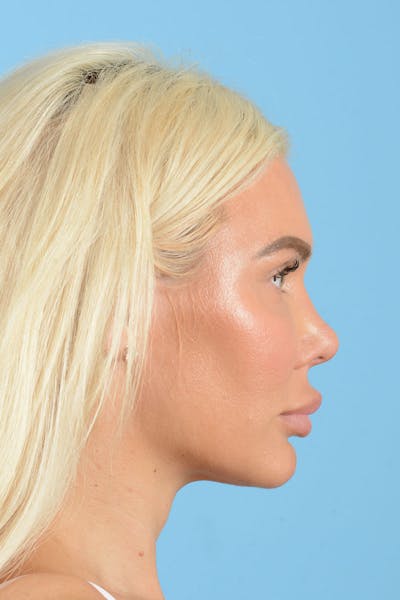 Rhinoplasty Before & After Gallery - Patient 472970 - Image 8