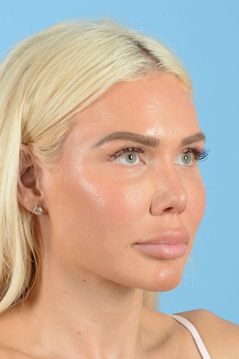 Rhinoplasty Before & After Gallery - Patient 472970 - Image 10