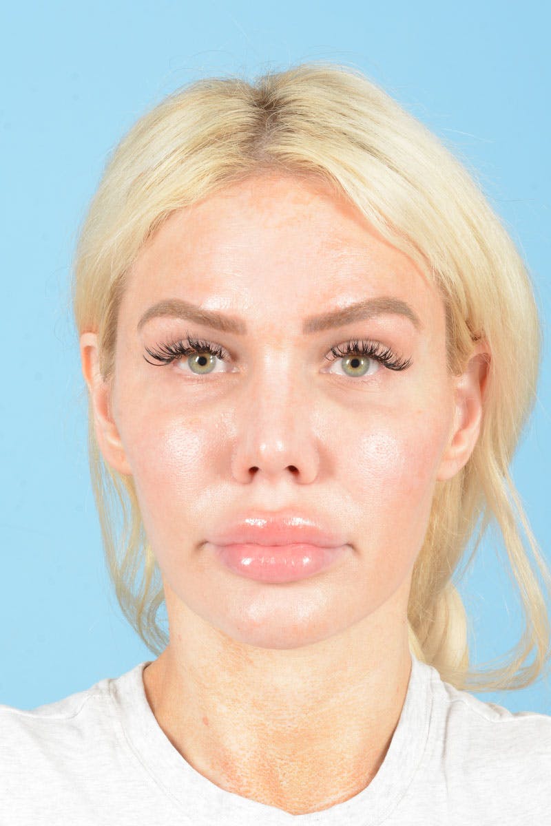 Rhinoplasty Before & After Gallery - Patient 472970 - Image 1