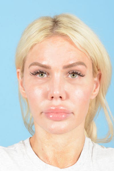 Rhinoplasty Before & After Gallery - Patient 472970 - Image 1