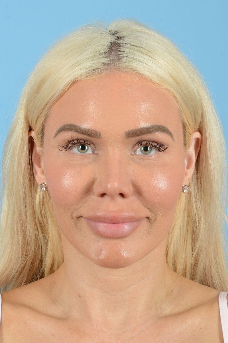 Rhinoplasty Before & After Gallery - Patient 472970 - Image 2