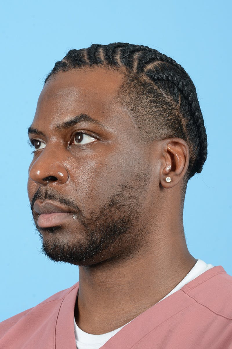 Facial Augmentation Before & After Gallery - Patient 264591 - Image 9