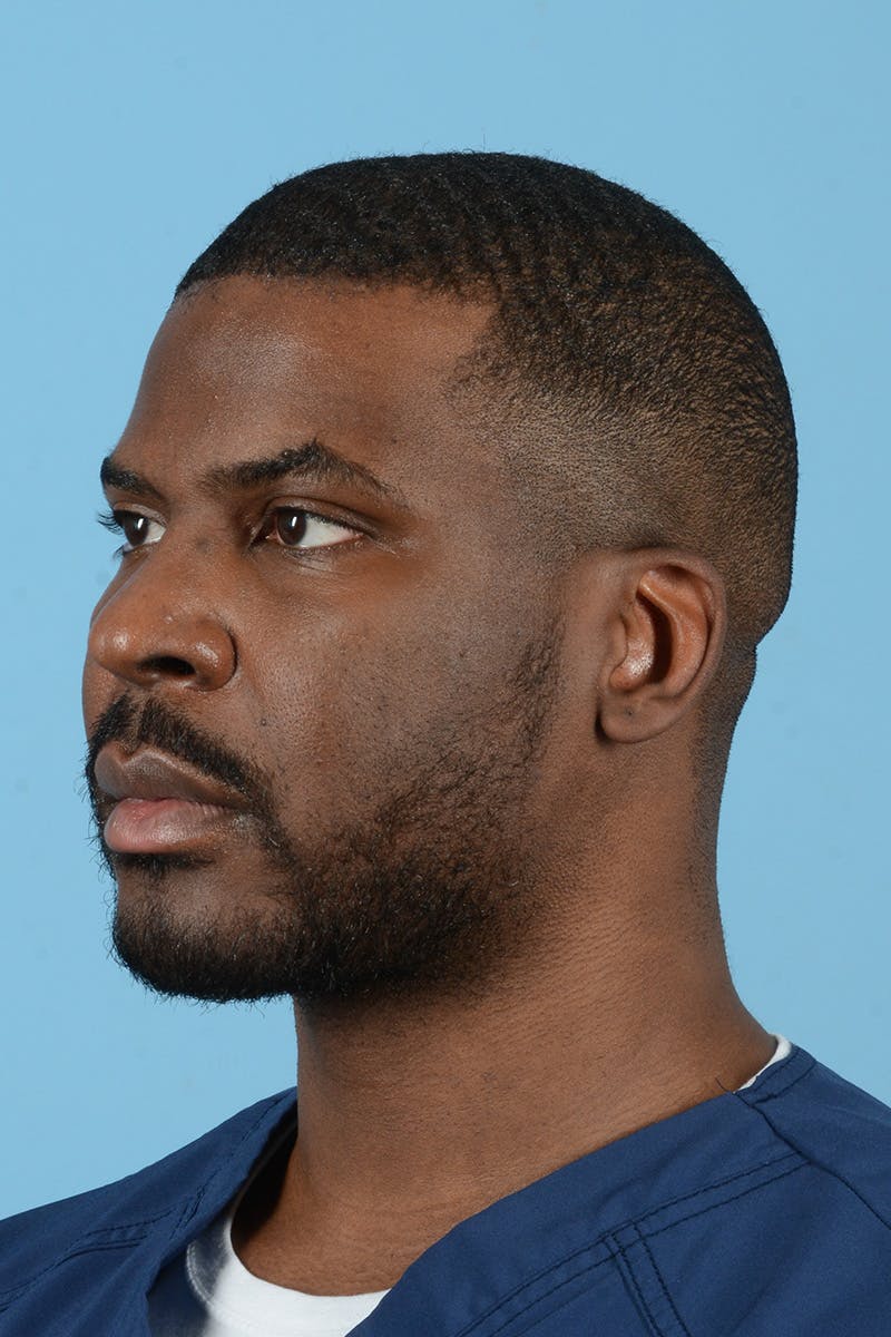 Facial Augmentation Before & After Gallery - Patient 264591 - Image 10