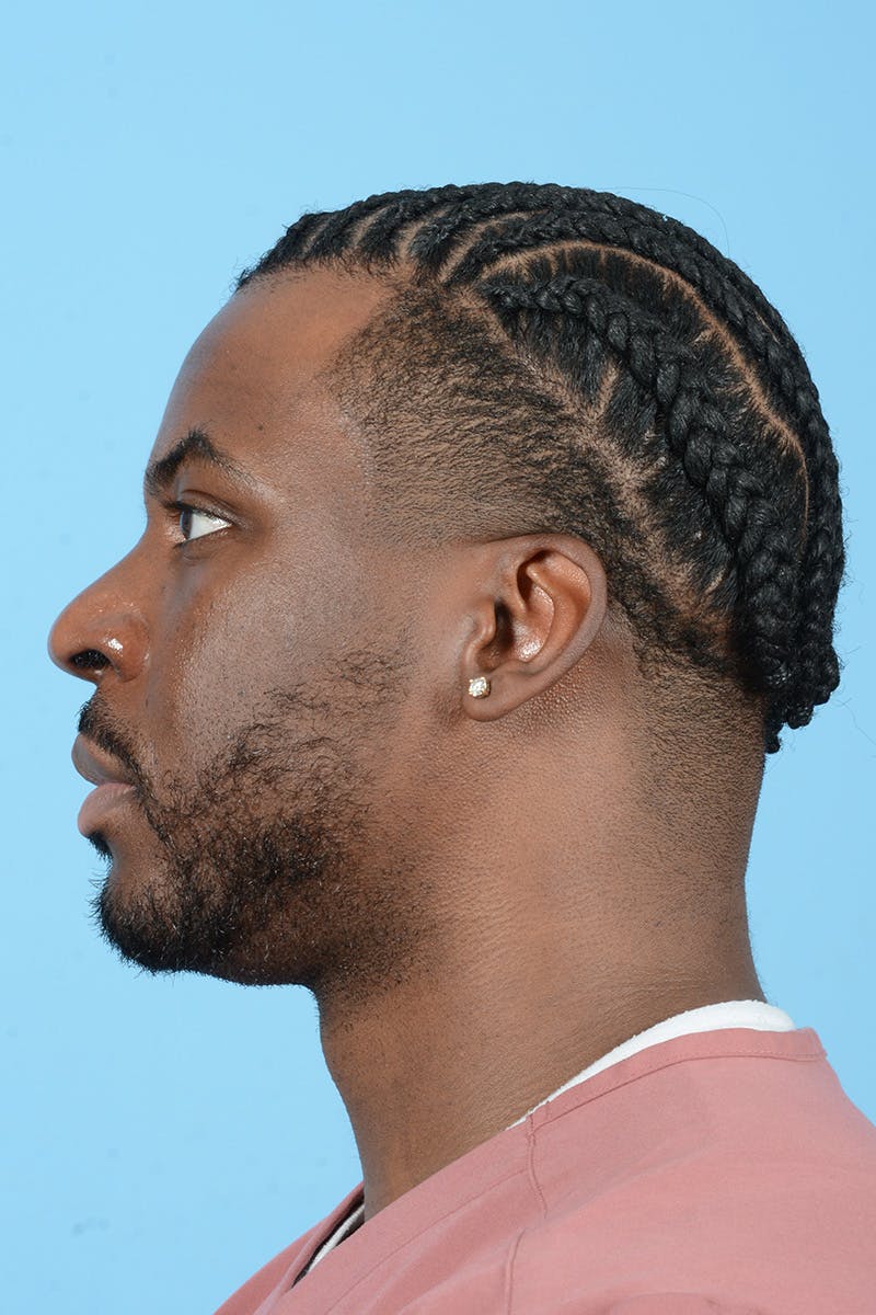 Facial Augmentation Before & After Gallery - Patient 264591 - Image 11