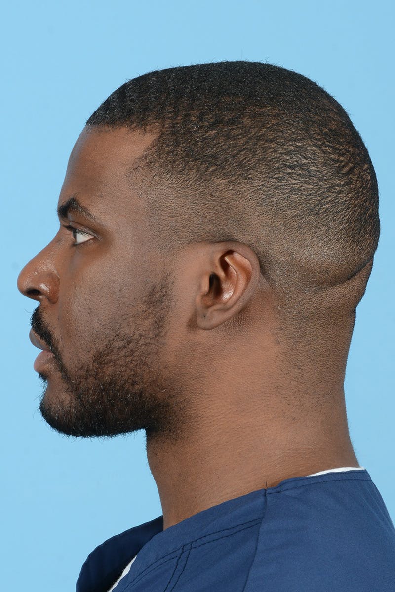 Facial Augmentation Before & After Gallery - Patient 264591 - Image 12