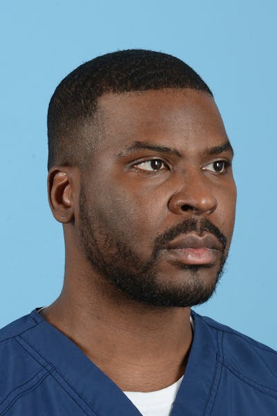 Facial Augmentation Before & After Gallery - Patient 264591 - Image 6