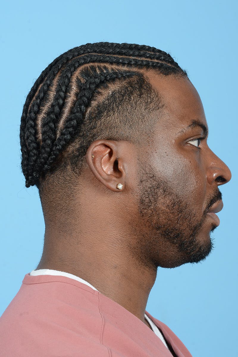 Facial Augmentation Before & After Gallery - Patient 264591 - Image 7