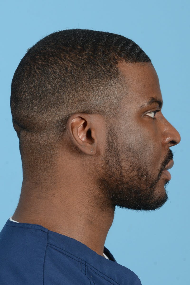 Facial Augmentation Before & After Gallery - Patient 264591 - Image 8