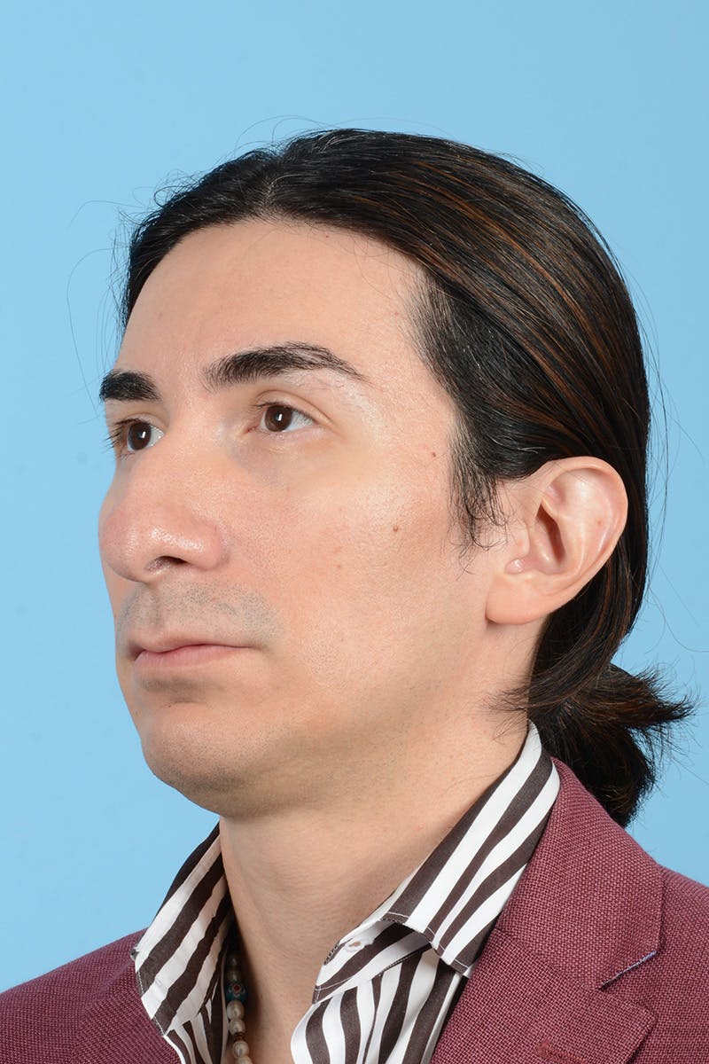 Facial Augmentation Before & After Gallery - Patient 402390 - Image 7
