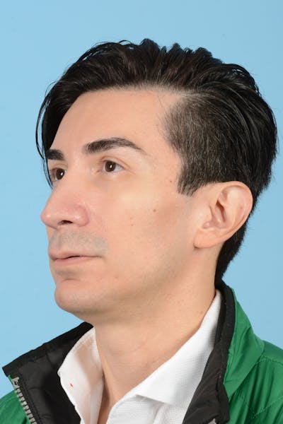 Facial Augmentation Before & After Gallery - Patient 402390 - Image 8