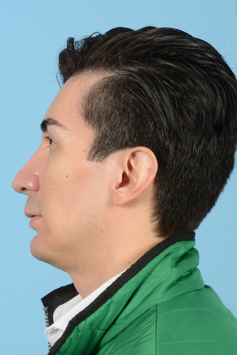 Facial Augmentation Before & After Gallery - Patient 402390 - Image 10