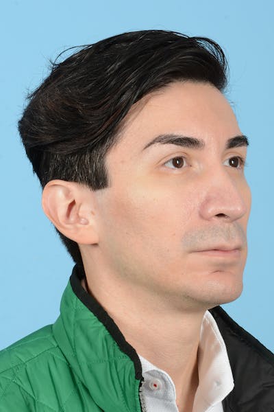 Facial Augmentation Before & After Gallery - Patient 402390 - Image 4