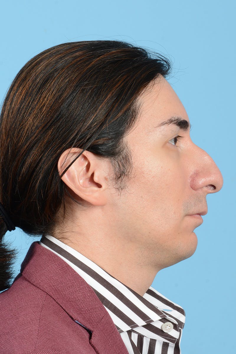 Facial Augmentation Before & After Gallery - Patient 402390 - Image 5
