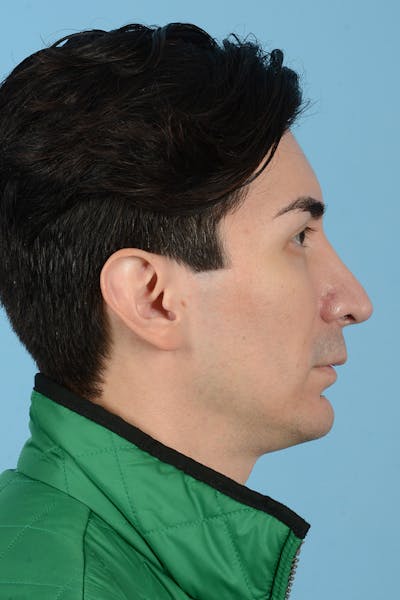 Facial Augmentation Before & After Gallery - Patient 402390 - Image 6