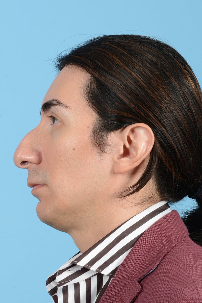 Facial Augmentation Before & After Gallery - Patient 402390 - Image 9