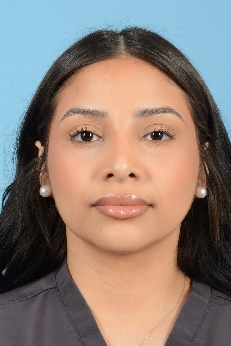 Rhinoplasty Before & After Gallery - Patient 216712 - Image 2