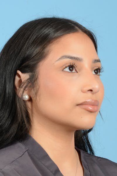 Rhinoplasty Before & After Gallery - Patient 216712 - Image 4