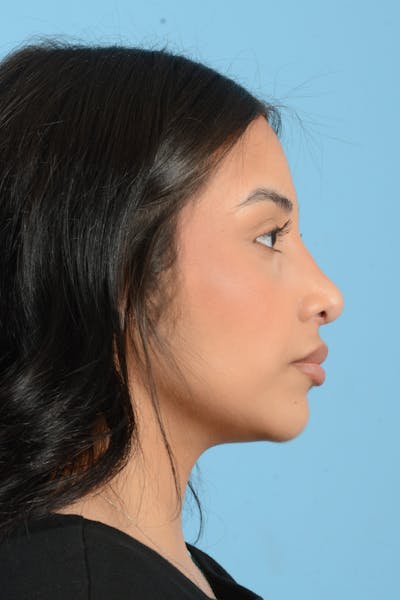 Rhinoplasty Before & After Gallery - Patient 216712 - Image 6