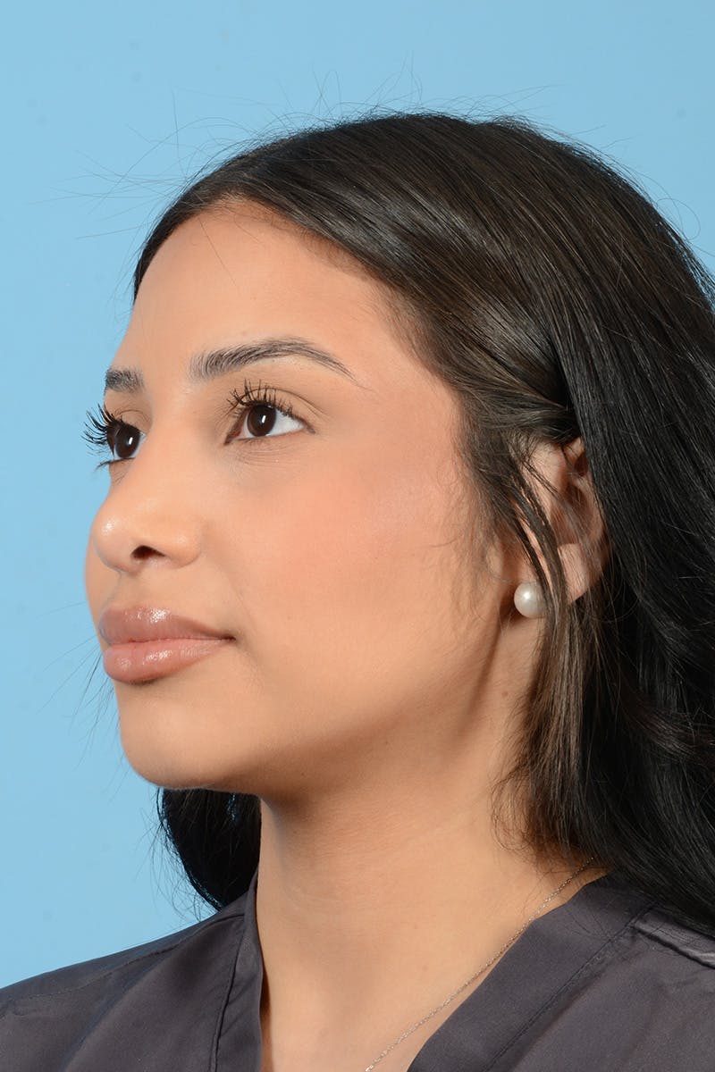 Rhinoplasty Before & After Gallery - Patient 216712 - Image 8