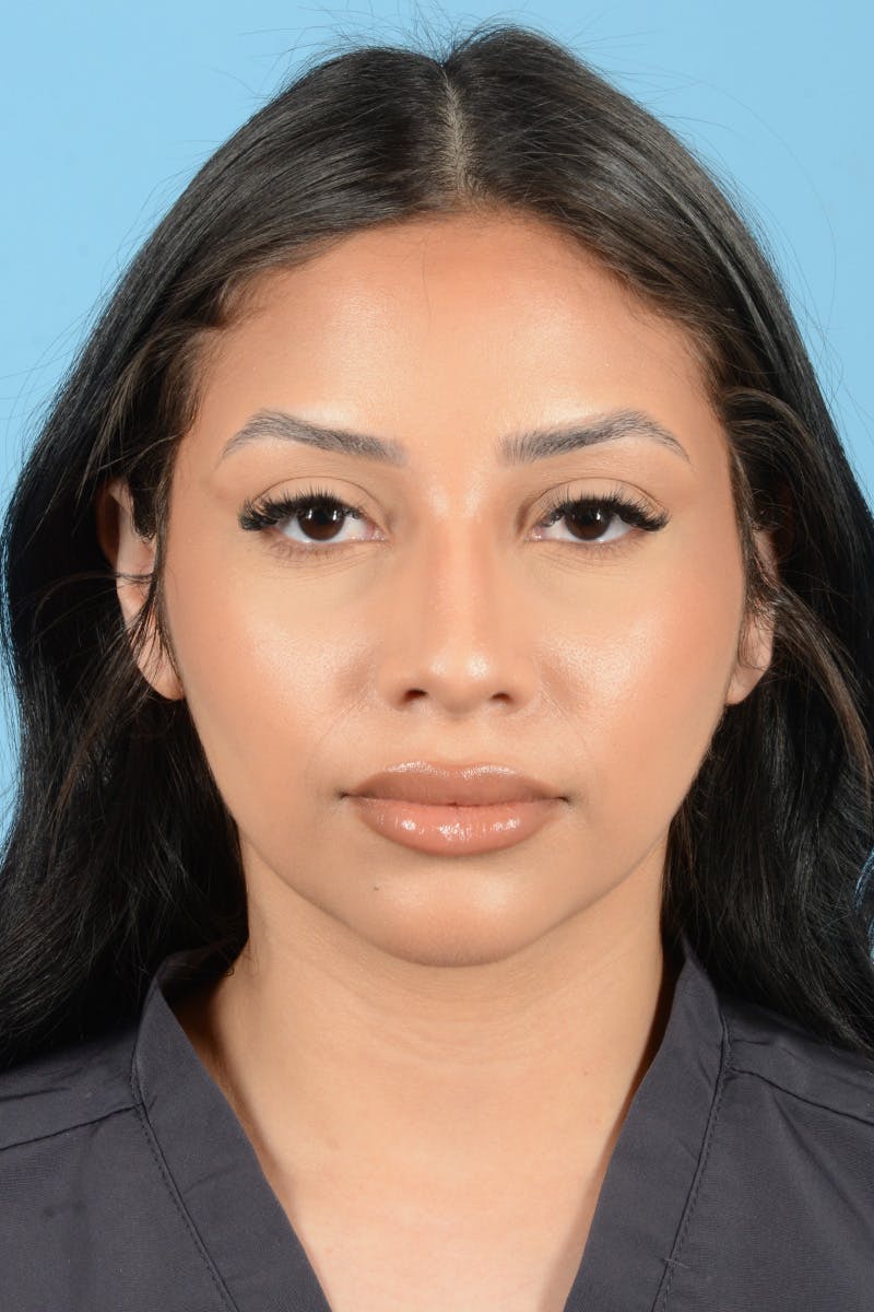 Rhinoplasty Before & After Gallery - Patient 216712 - Image 1