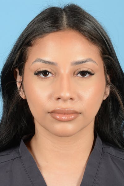 Rhinoplasty Before & After Gallery - Patient 216712 - Image 1