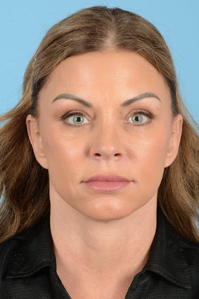 Facelift Before & After Gallery - Patient 208918 - Image 2
