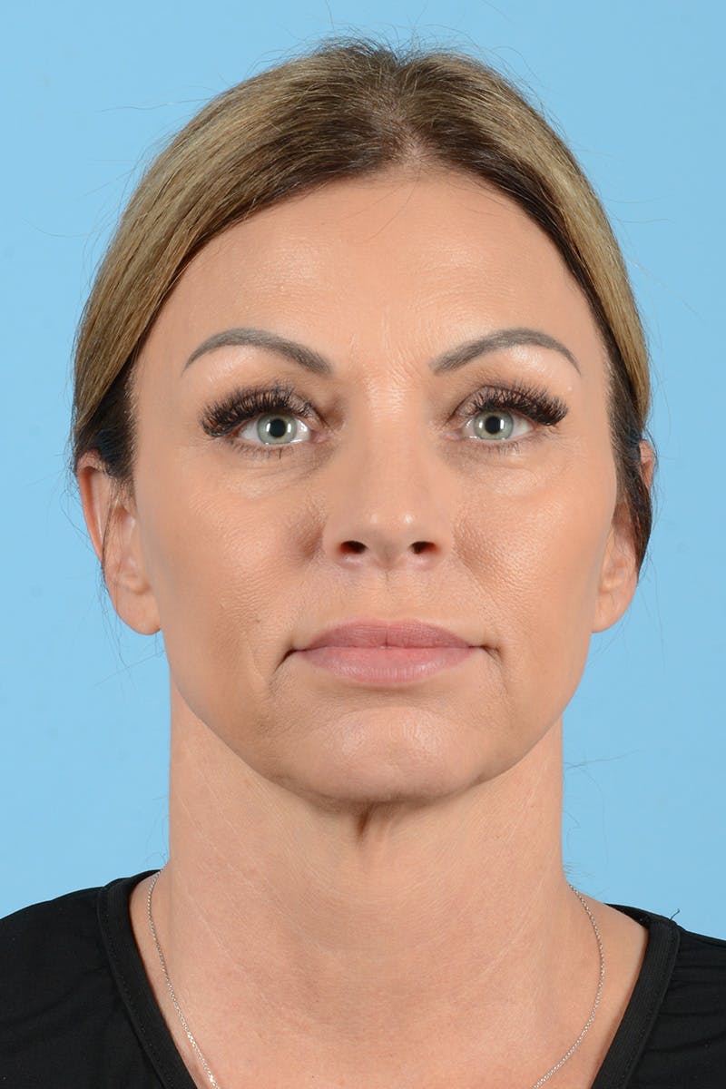 Facelift Before & After Gallery - Patient 208918 - Image 1