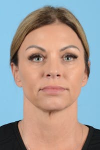 Facelift Before & After Gallery - Patient 208918 - Image 1