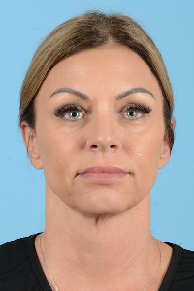 Facelift Before & After Gallery - Patient 208918 - Image 1