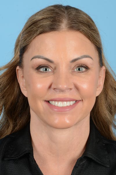 Facelift Before & After Gallery - Patient 208918 - Image 4