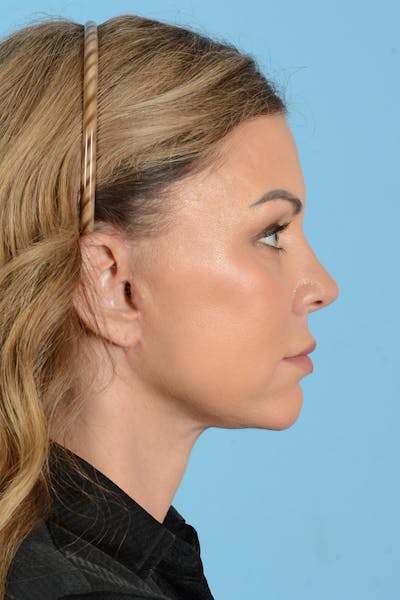 Facelift Before & After Gallery - Patient 208918 - Image 12