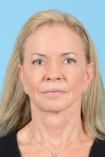 Facelift Before & After Gallery - Patient 228959 - Image 2