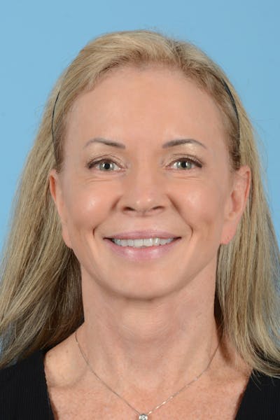 Facelift Before & After Gallery - Patient 228959 - Image 4
