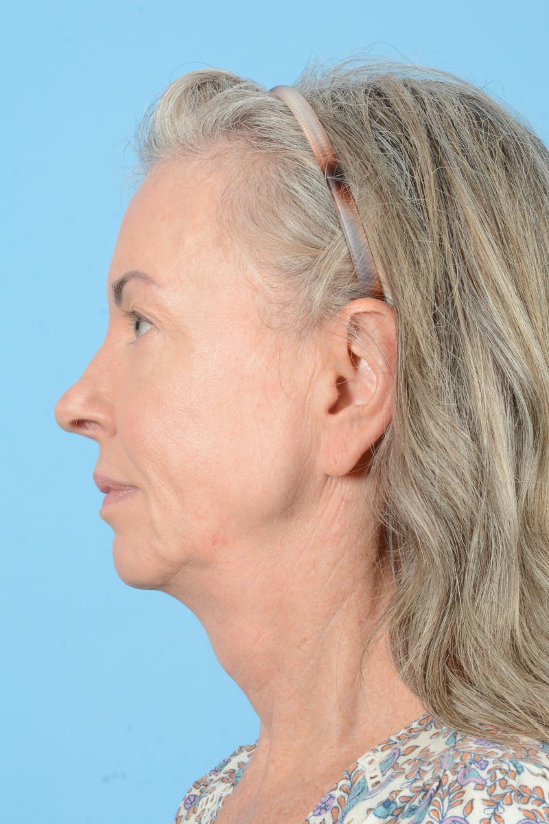 Facelift Before & After Gallery - Patient 228959 - Image 11
