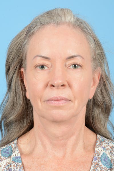 Facelift Before & After Gallery - Patient 228959 - Image 1
