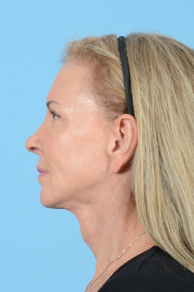 Facelift Before & After Gallery - Patient 228959 - Image 12