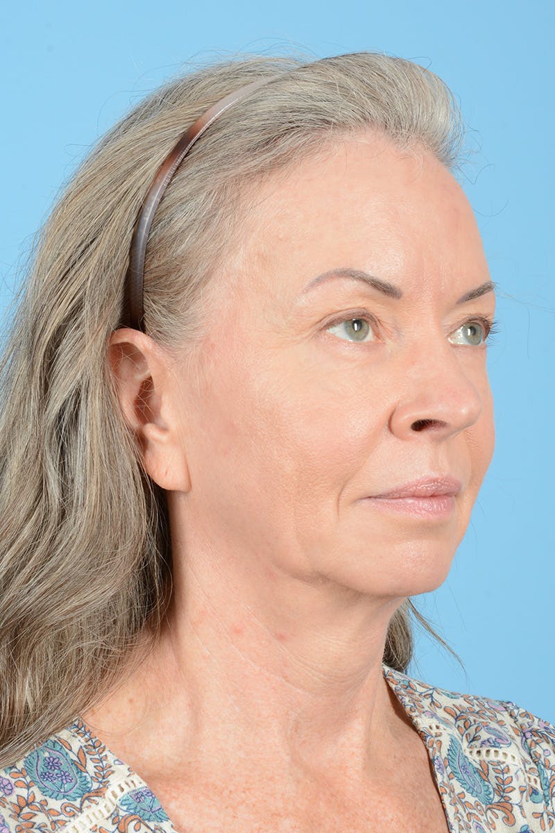 Facelift Before & After Gallery - Patient 228959 - Image 5