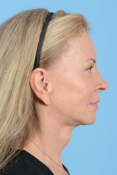 Facelift Before & After Gallery - Patient 228959 - Image 8