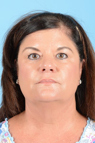 Facelift Before & After Gallery - Patient 214856 - Image 1