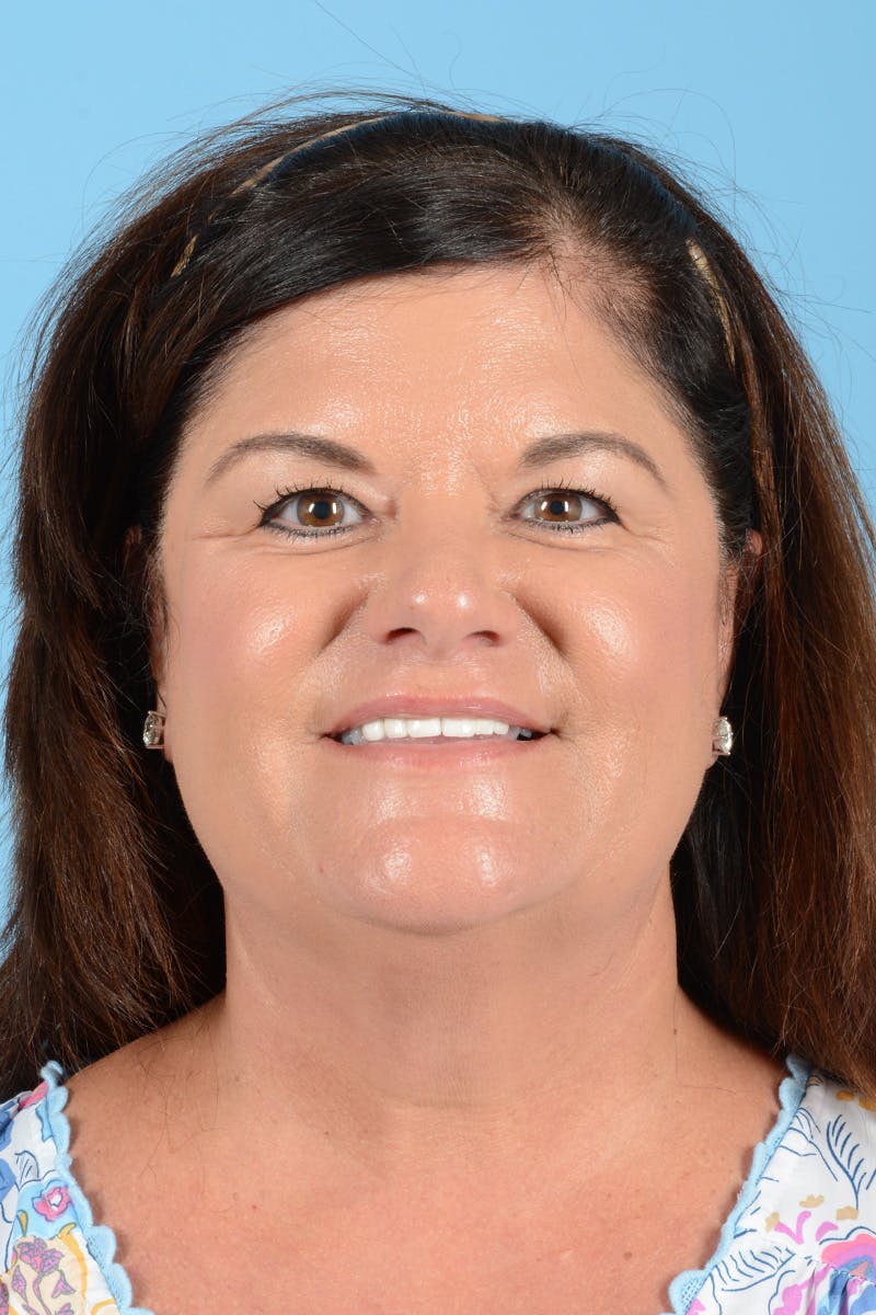 Facelift Before & After Gallery - Patient 214856 - Image 3
